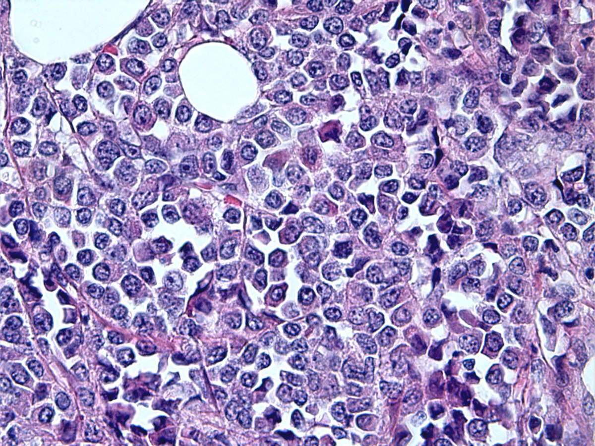 Extramedullary APL, small bowel (40X)